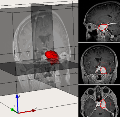 Brain-tumor-composite-seg.png