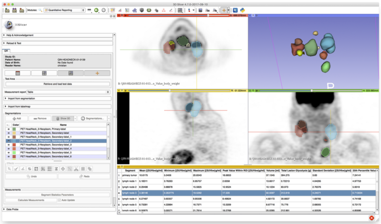 Quantitative PET-CT Image Analysis for Treatment Outcome Prediction.png